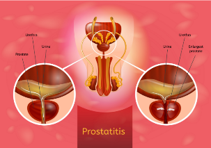 prosztatagyulladás tünetei és kezelési tabletták)