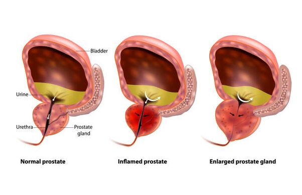 prostatitis gyümölcs)
