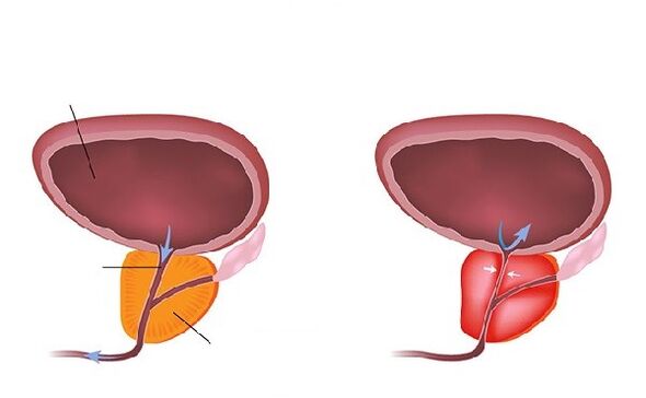 normál és gyulladt prosztata